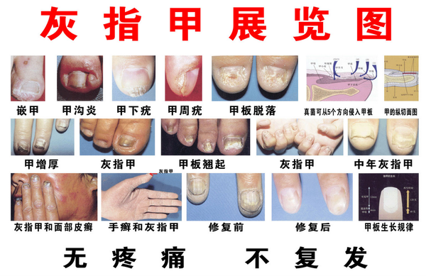 牛皮癣最新治疗方法与步骤指南，适合初学者及进阶用户参考